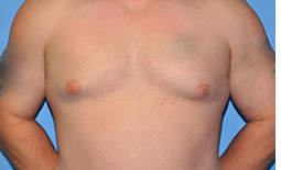 Gynecomastia Before and After Pictures Plano, TX