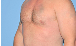 Gynecomastia Before and After Pictures Plano, TX