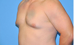 Gynecomastia Before and After Pictures Plano, TX