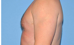 Gynecomastia Before and After Pictures Plano, TX