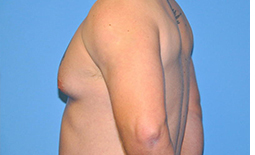 Gynecomastia Before and After Pictures Plano, TX