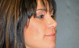 Rhinoplasty Before and After Pictures Plano, TX