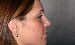 Rhinoplasty Before and After Pictures Plano, TX