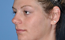 Rhinoplasty Before and After Pictures Plano, TX