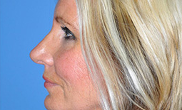 Rhinoplasty Before and After Pictures Plano, TX