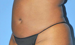 Liposuction Before and After Pictures Plano, TX