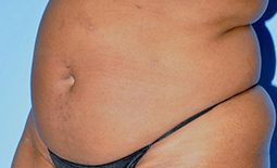 Liposuction Before and After Pictures Plano, TX