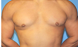 Gynecomastia Before and After Pictures Plano, TX