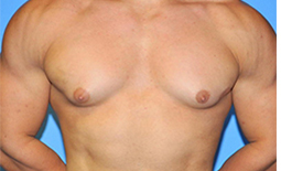 Gynecomastia Before and After Pictures Plano, TX