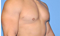 Gynecomastia Before and After Pictures Plano, TX