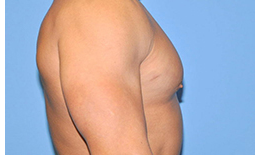 Gynecomastia Before and After Pictures Plano, TX