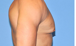 Gynecomastia Before and After Pictures Plano, TX