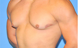 Gynecomastia Before and After Pictures Plano, TX