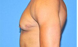 Gynecomastia Before and After Pictures Plano, TX