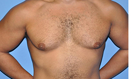 Gynecomastia Before and After Pictures Plano, TX