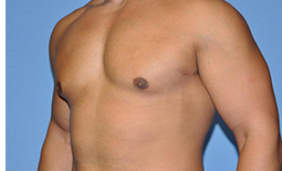 Gynecomastia Before and After Pictures Plano, TX