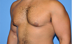 Gynecomastia Before and After Pictures Plano, TX