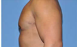 Gynecomastia Before and After Pictures Plano, TX