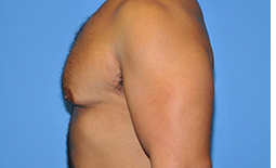 Gynecomastia Before and After Pictures Plano, TX