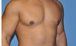 Gynecomastia Before and After Pictures Plano, TX