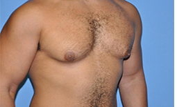 Gynecomastia Before and After Pictures Plano, TX