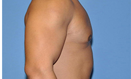 Gynecomastia Before and After Pictures Plano, TX