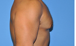Gynecomastia Before and After Pictures Plano, TX