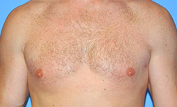 Gynecomastia Before and After Pictures Plano, TX