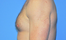 Gynecomastia Before and After Pictures Plano, TX