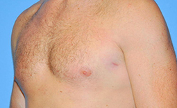 Gynecomastia Before and After Pictures Plano, TX