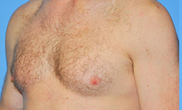 Gynecomastia Before and After Pictures Plano, TX