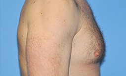 Gynecomastia Before and After Pictures Plano, TX