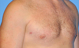 Gynecomastia Before and After Pictures Plano, TX