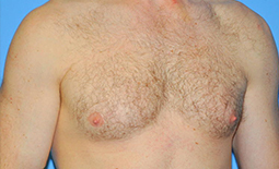 Gynecomastia Before and After Pictures Plano, TX