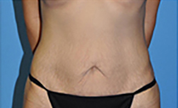 Tummy Tuck Before and After Pictures Plano, TX