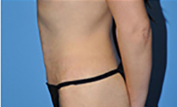 Tummy Tuck Before and After Pictures Plano, TX