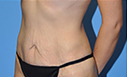 Tummy Tuck Before and After Pictures Plano, TX