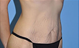 Tummy Tuck Before and After Pictures Plano, TX