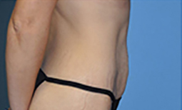 Tummy Tuck Before and After Pictures Plano, TX