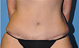 Tummy Tuck Before and After Pictures Plano, TX