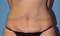 Tummy Tuck Before and After Pictures Plano, TX