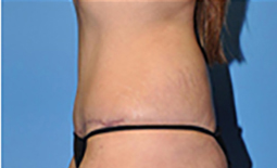 Tummy Tuck Before and After Pictures Plano, TX