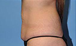 Tummy Tuck Before and After Pictures Plano, TX