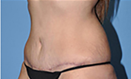 Tummy Tuck Before and After Pictures Plano, TX