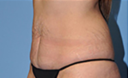 Tummy Tuck Before and After Pictures Plano, TX