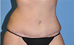 Tummy Tuck Before and After Pictures Plano, TX