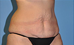 Tummy Tuck Before and After Pictures Plano, TX