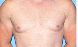 Gynecomastia Before and After Pictures Plano, TX