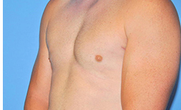 Gynecomastia Before and After Pictures Plano, TX