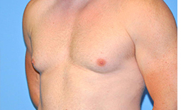 Gynecomastia Before and After Pictures Plano, TX